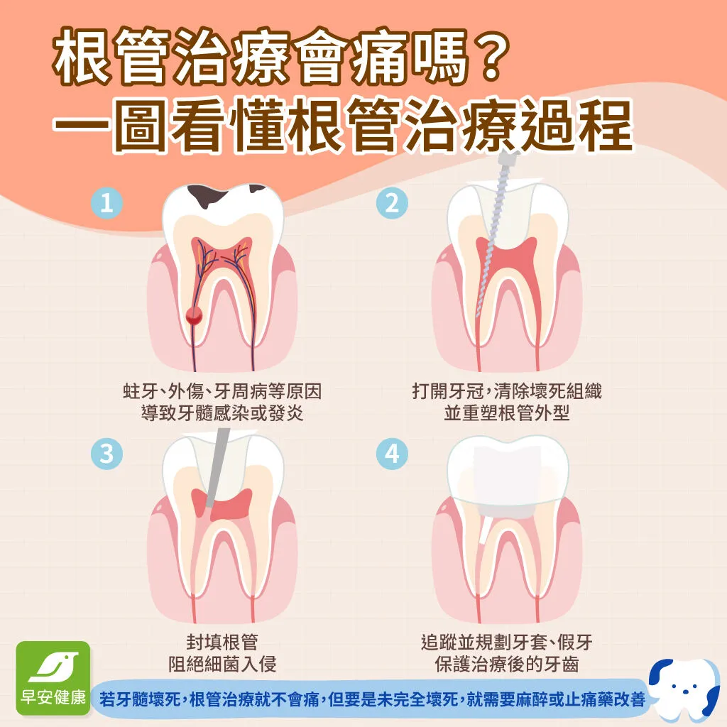 根管治療會痛嗎-根管治療流程-根管治療
